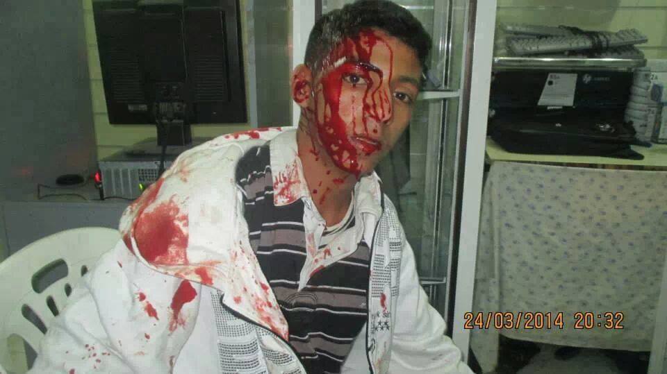 Hamza Lansari 16 years old, tortured by Moroccan police. (By AdalaUK Members)